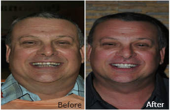 USA resident Randy Berthelette Got Permanent Solution in India for his Stained Teeth