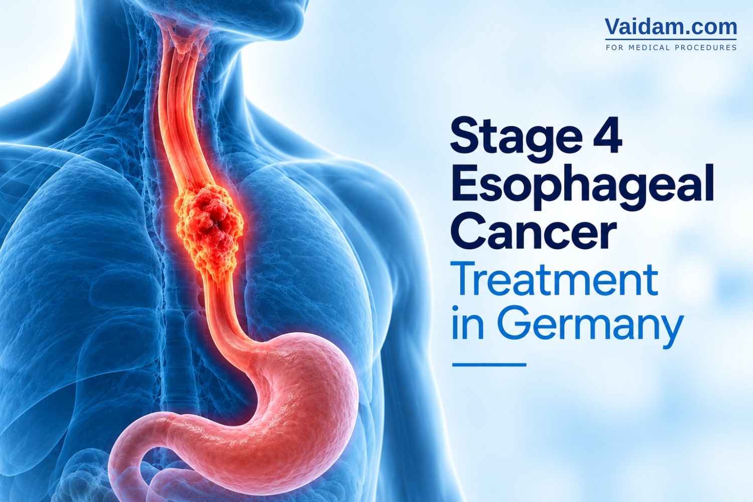 Stage 4 Esophageal Cancer Treatment in Germany