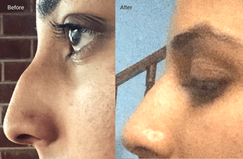 Happy with her Rhinoplasty Treatment in India, Here is What Shabana from the U.S has to Say about Her Medical Trip