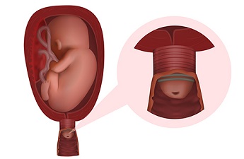 Cervical Cerclage and its procedure by Gynaecologist and Obstetrician Dr. Sunila Khandelwal