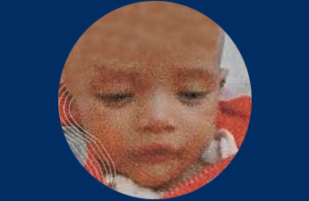 5-Months Old Zamzam Abdinur Ahmed from Somalia Got Normal Heart Function After Treatment in Medanta
