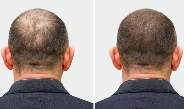 intro image hair transplant