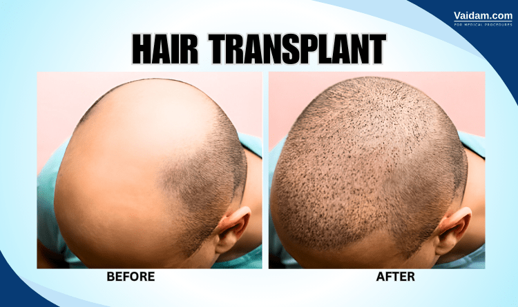  before and after 
