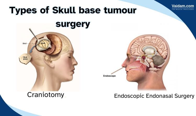 Types of skull base tumour surgery