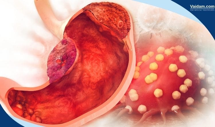 Cancer of stomach