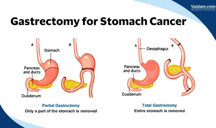 gastrectomy