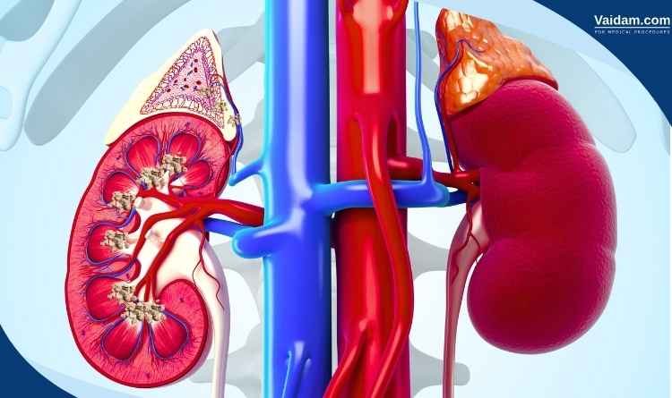 Kidney stones