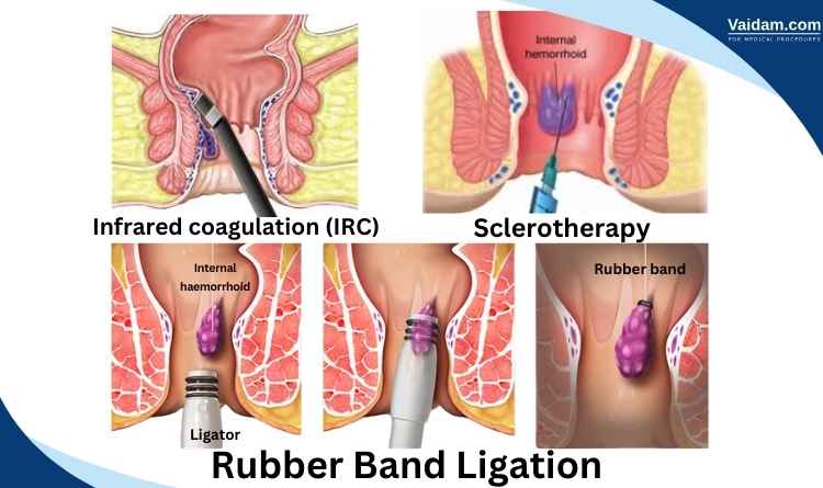 Non-surgical procedures