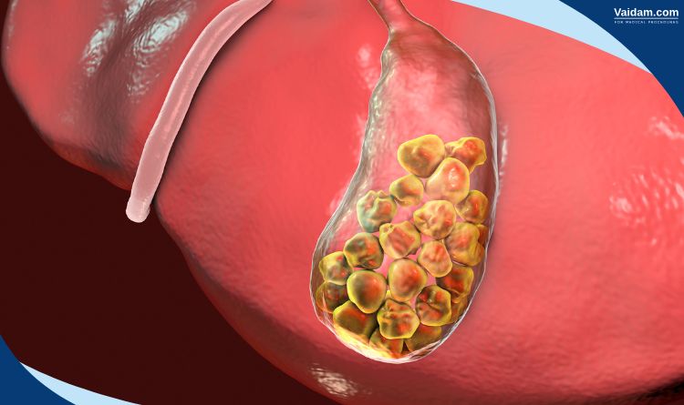 Gall bladder cancer