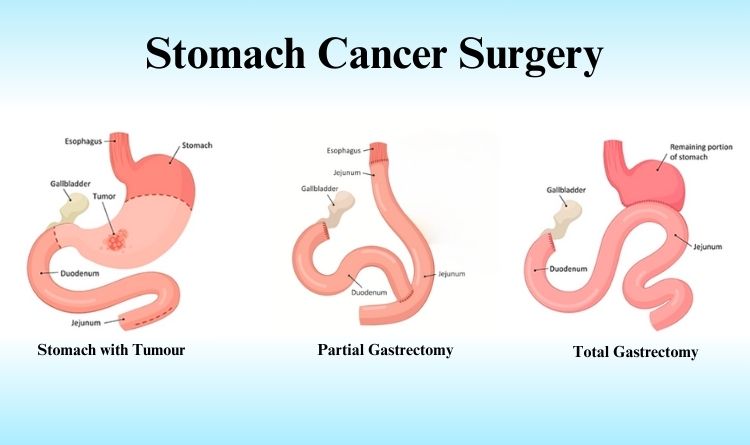 Stomach cancer surgery
