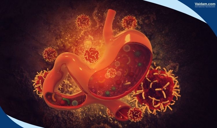 Stomach Cancer Intro image
