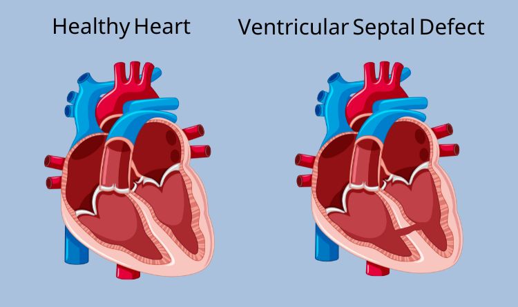 Comparison between healthy and VSD heart