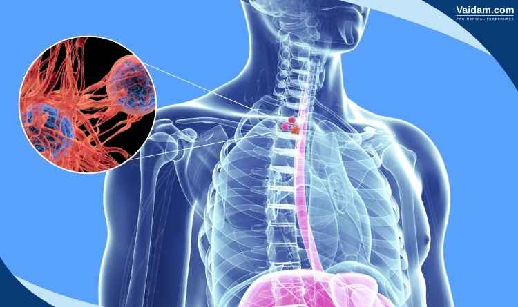 Oesophageal cancer image