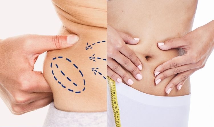 Before and After liposuction 
