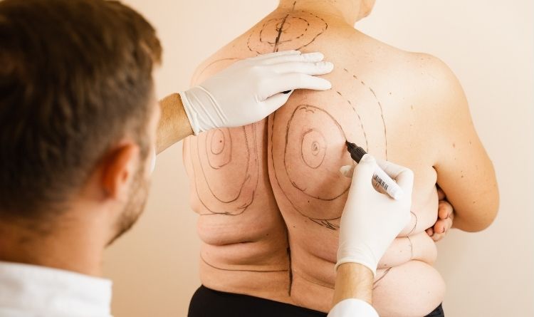 Liposuction in India