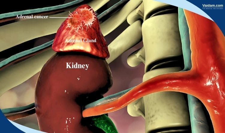 Adrenal Cancer location