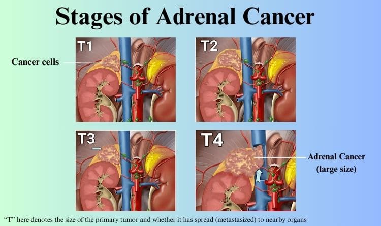 Stages of Adrenal Cancer