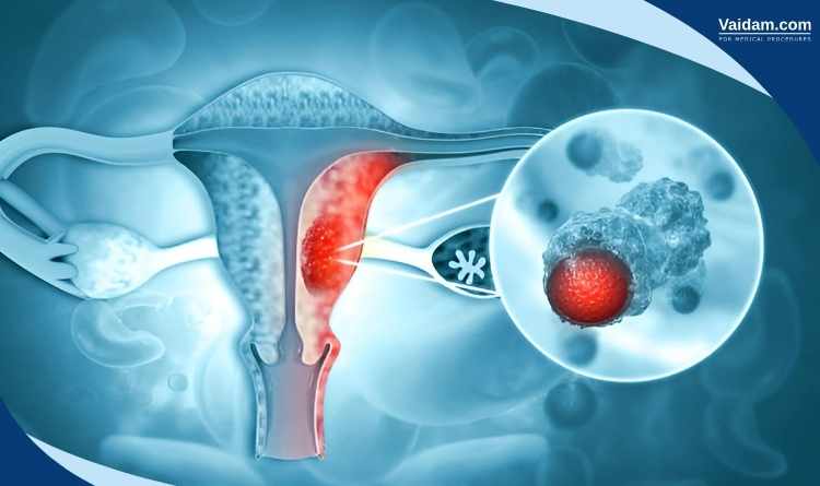 Cervical Cancer Treatment in India