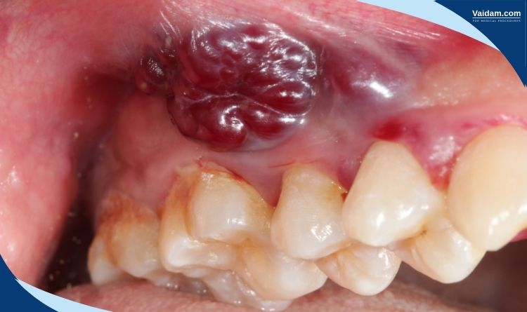 Oral cancer