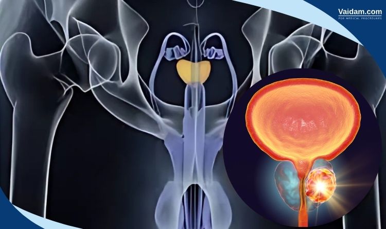 Prostate cancer representation