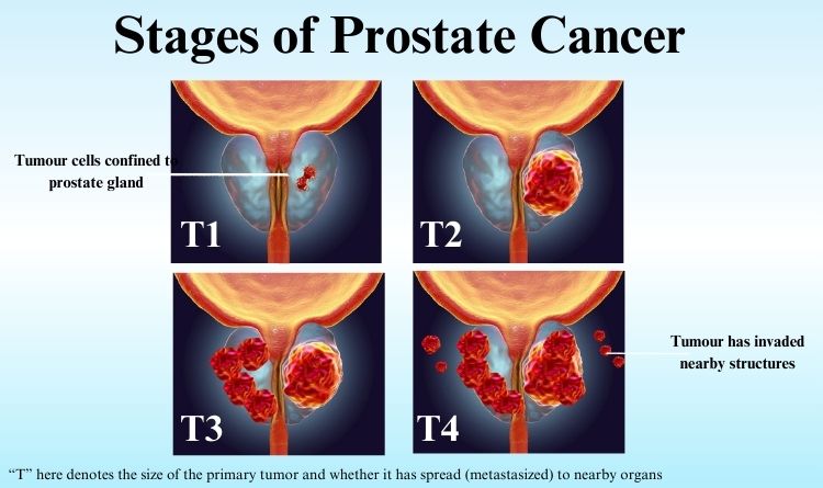 stages of prostate cancer