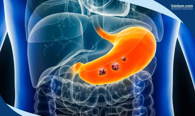 Impact of Neoadjuvant Therapy in Treating Stomach Cancer