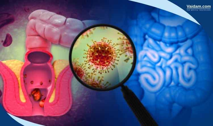 Anal Cancer Treatment in India