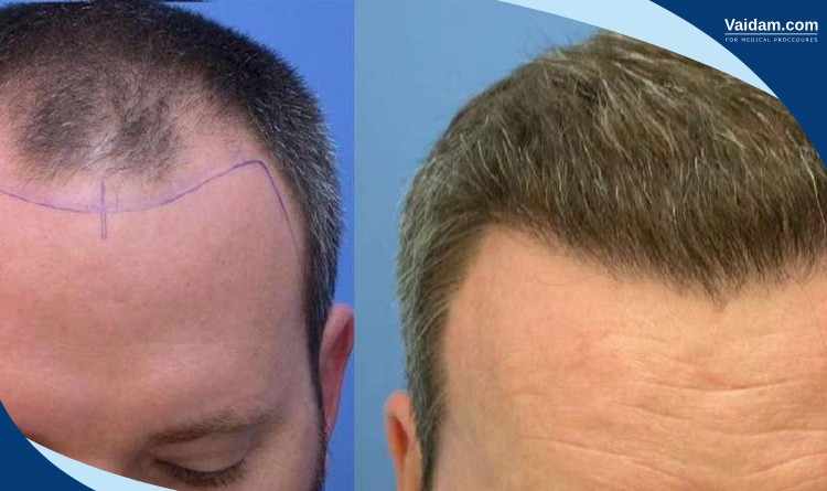 Hair transplant in turkey