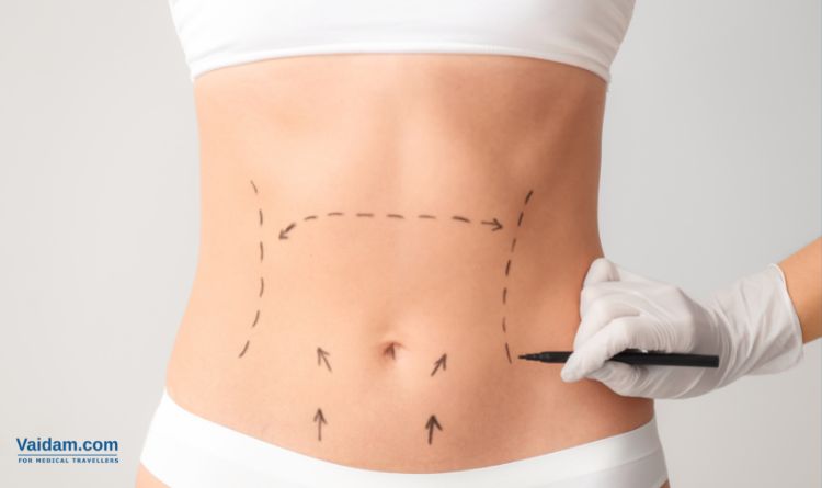 Abdominoplasty