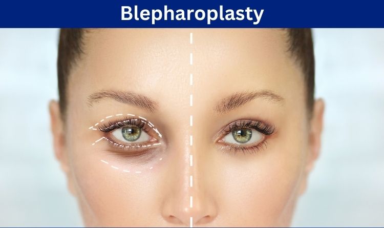 Blepharoplasty