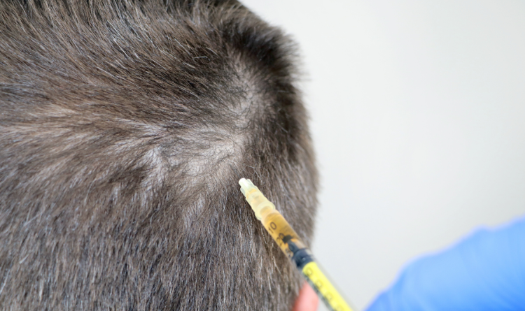 Hair Transplant