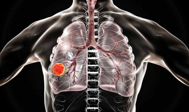 Role-of-immunotherapy-in-lung-cancer