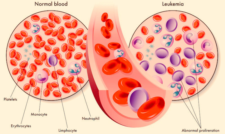 acute myeloid leukemia