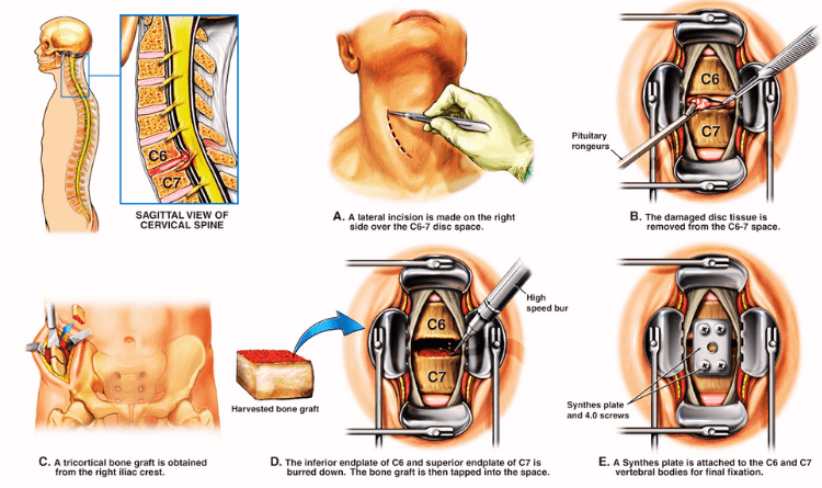 anterior cervical discectomy procedure