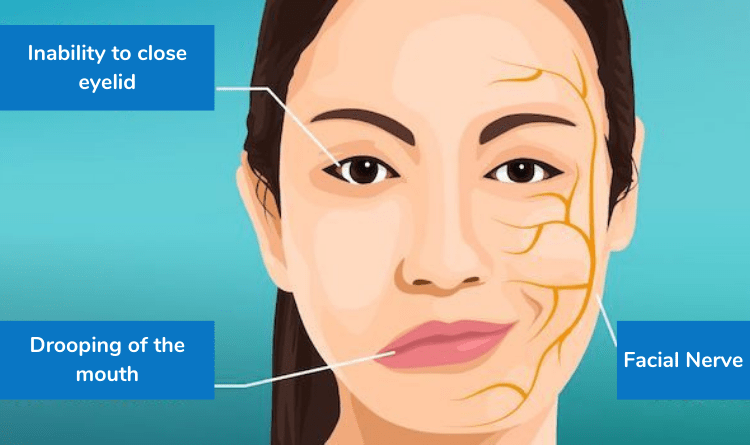 bells-palsy