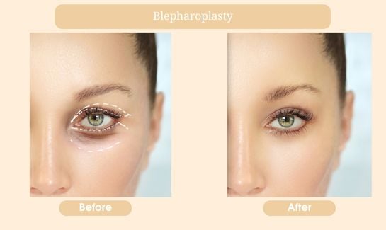 Blepharoplasty