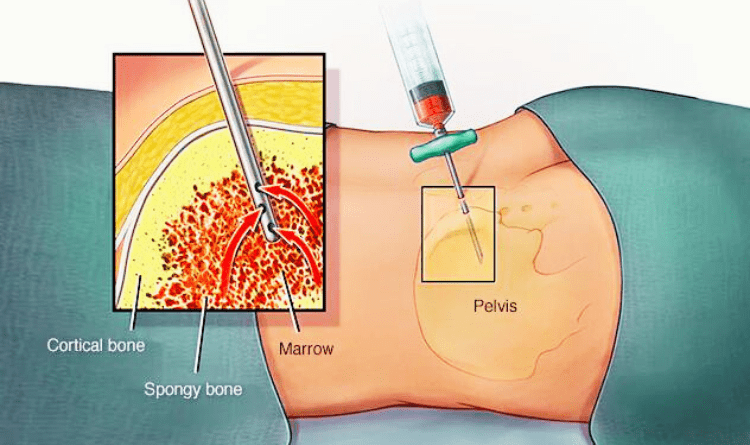 bone marrow test