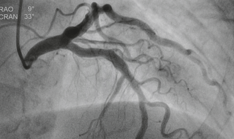 angiogram