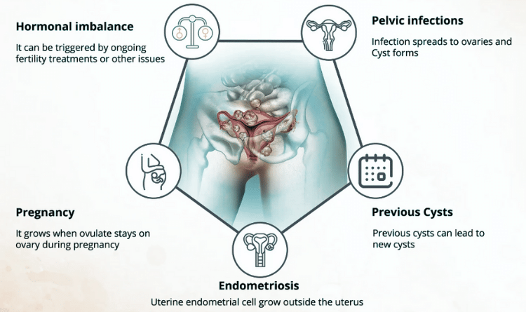 causes of ovarian cyst