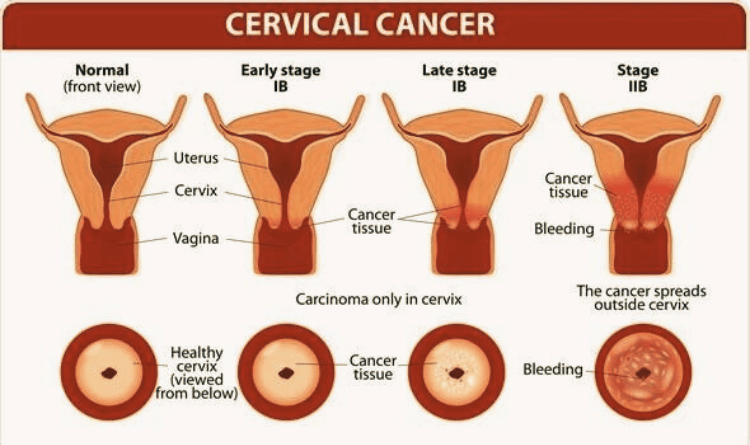 cervical-cancer