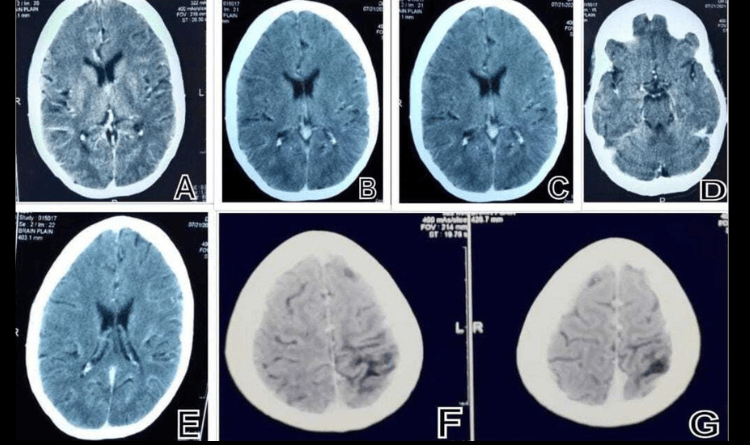 brain