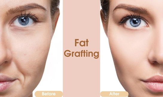 Fat Grafting