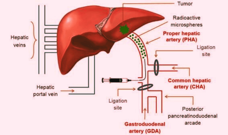 tare procedure