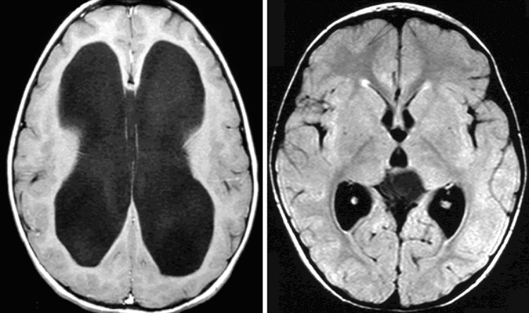 hydrocephalusintromin