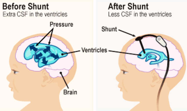 hydrocephalusshuntmin