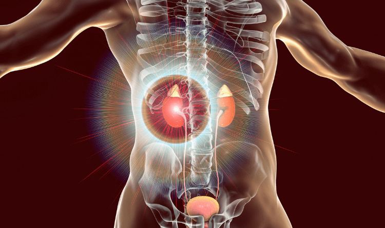 kidney cancer