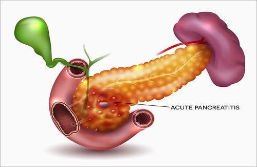 Pancreatitis Pancreatitis