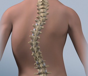 Scoliosis