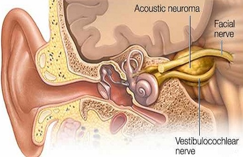 acoustic neuroma