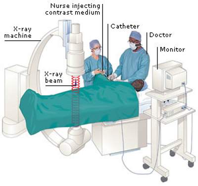 Angiography